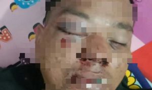 Iskandar Korban Penganiayaan Sangat Kecewa Pada Penegak Hukum Polresta Deli Serdang